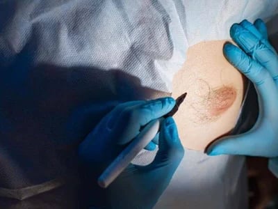 Brustvergrößerung mit Straffung in Bochum: Vertrauen Sie unserer langjährigen Erfahrung