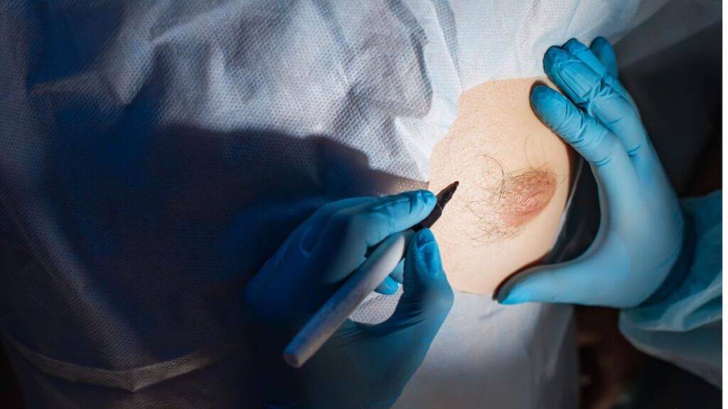 Brustvergrößerung mit Straffung in Bochum: Vertrauen Sie unserer langjährigen Erfahrung