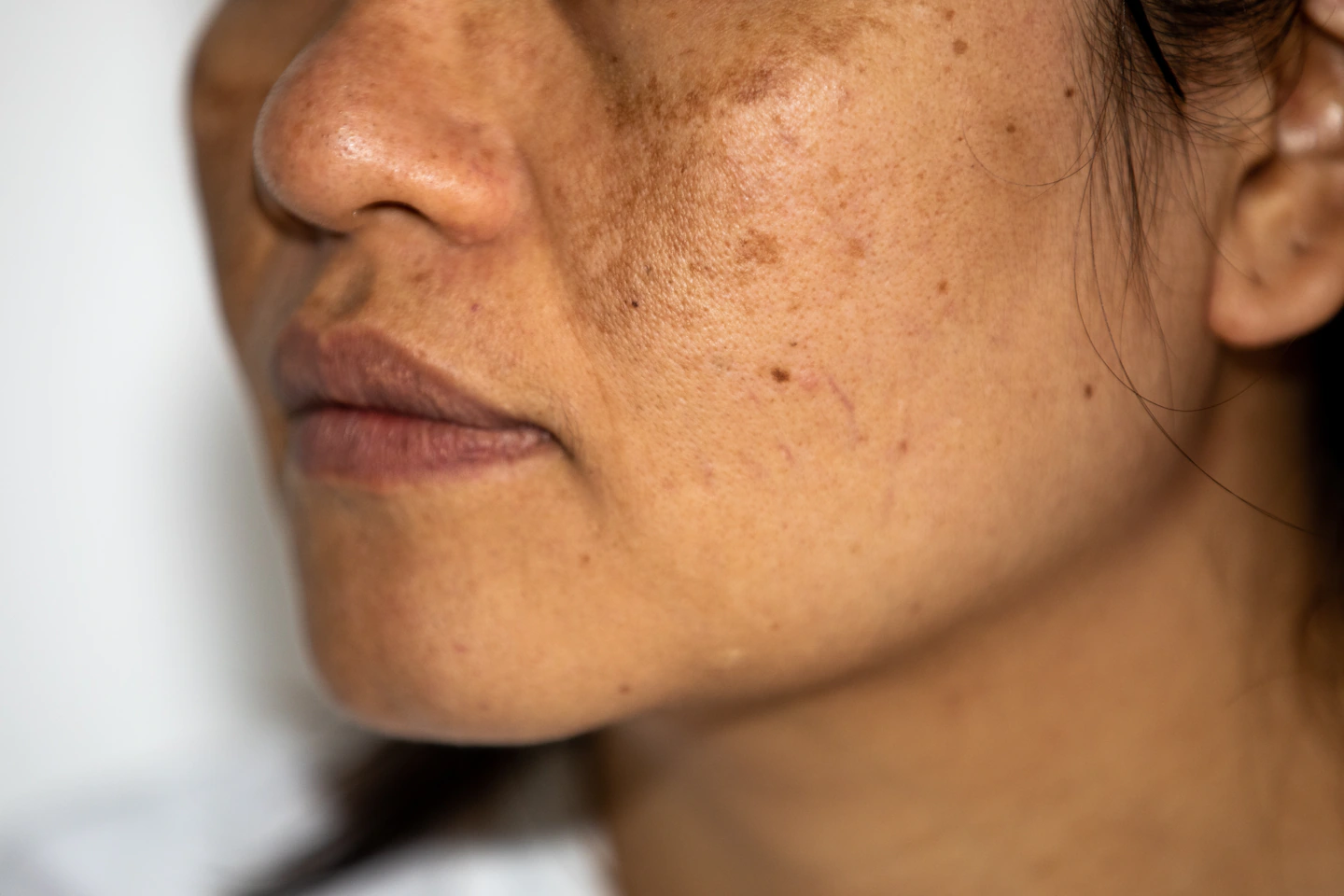 Ästhetische Innovation mit harmony ca bei MorySkin entdecken